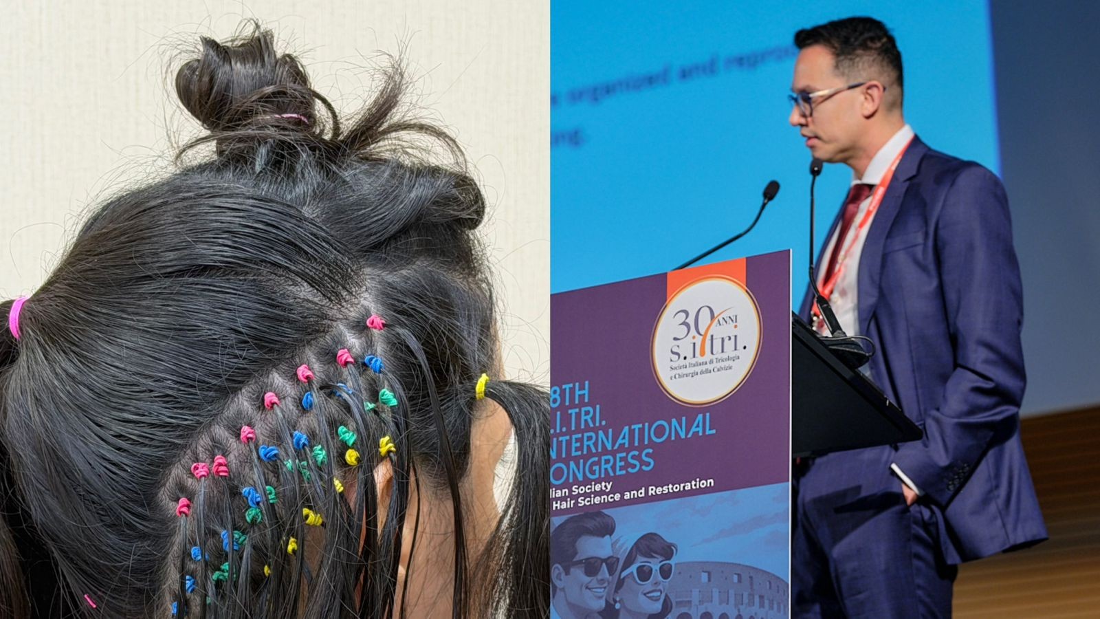 Médico brasileiro Elson Viana publica técnica de transplante capilar em periódico internacional e recebe reconhecimentos em congressos