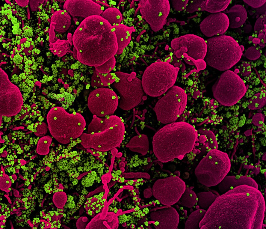 Novo SARS-CoV-2 de Coronavírus Micrografia eletrônica de varredura colorida de uma célula apoptótica (rosa) fortemente infectada com partículas do vírus SARS-COV-2 (verde), isoladas de uma amostra de paciente. Imagem capturada no NIAID Integrated Research Facility (IRF) em Fort Detrick, Maryland.