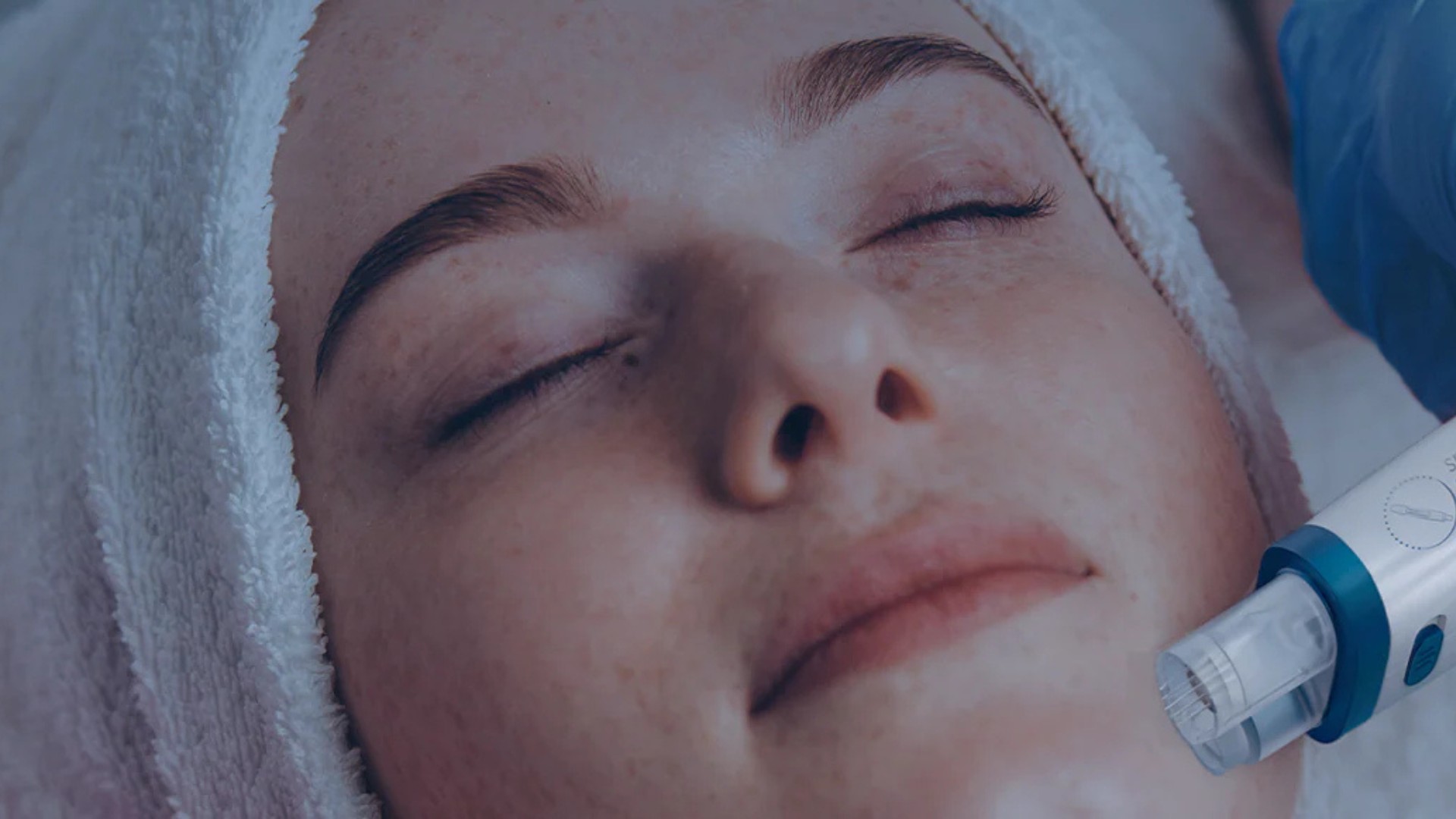 Técnica de microagulhamento ganha novas tecnologias em 2025