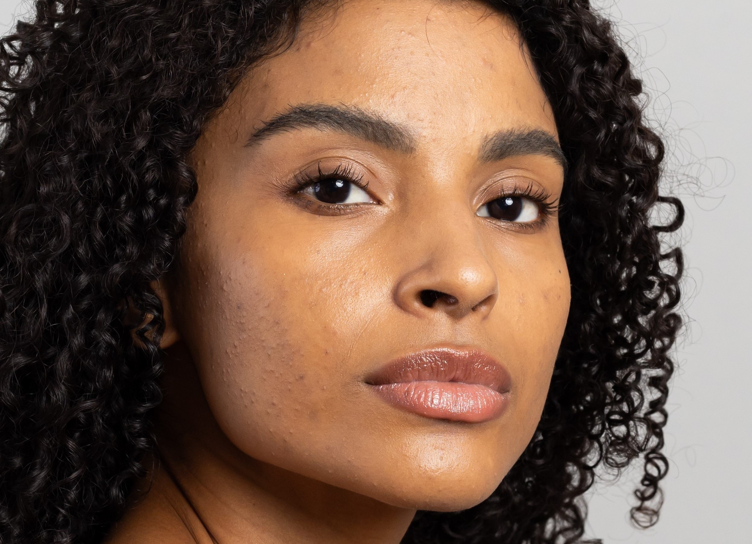 Mês da Acne: Entenda Causas e Cuidados Essenciais