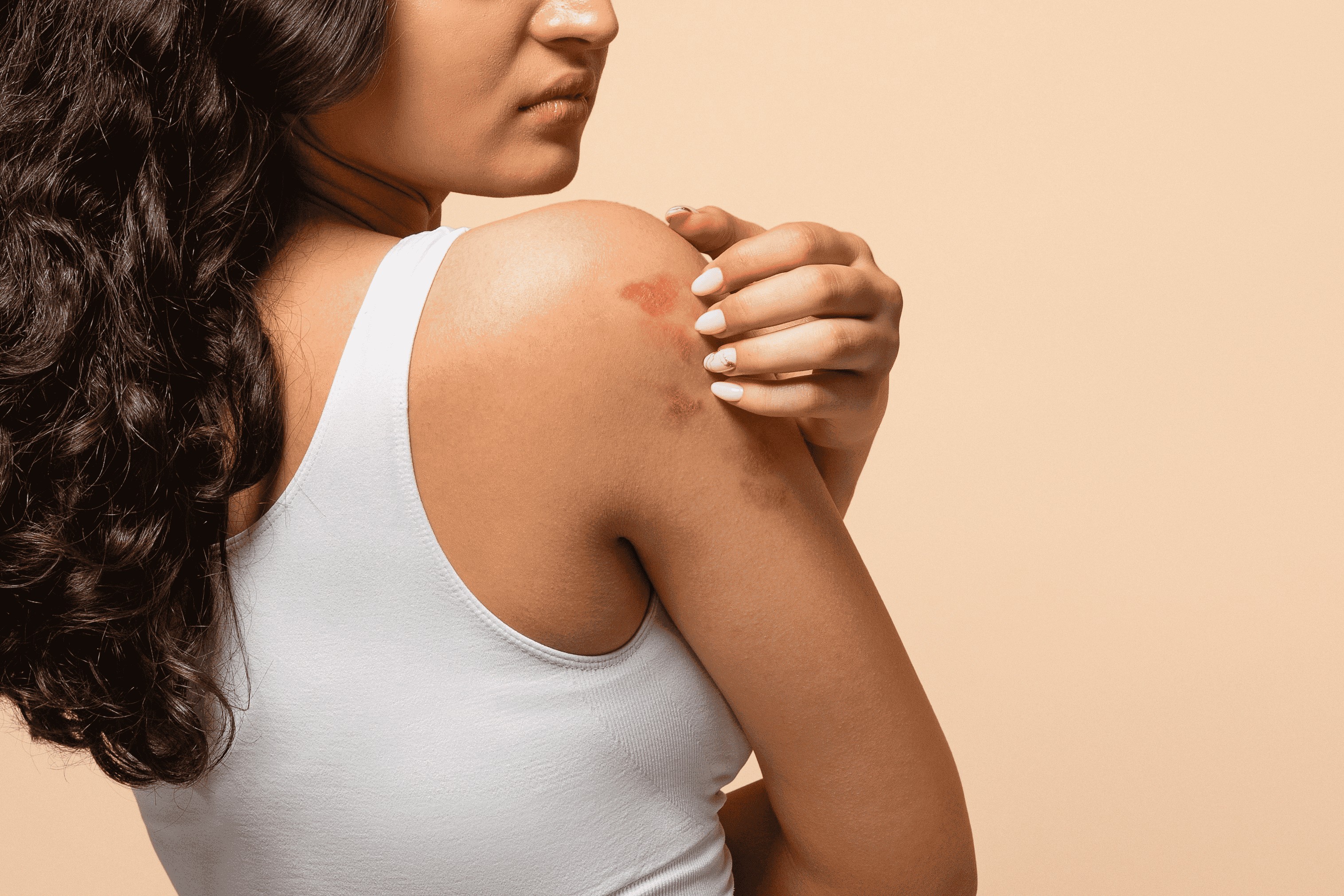 Mês da Dermatite Atópica: os impactos da doença na pele